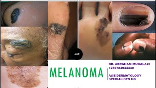 UPDATES ON MELANOMA BY DR ABRAHAM SKINCANCER education dermatology [upl. by Survance356]