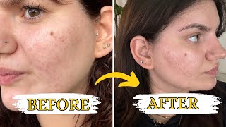 My acne scars after Laser Genesis Treatments [upl. by Amitarp]