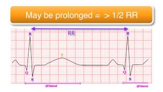 ECG basics 1010  The QT Interval [upl. by Fabron882]