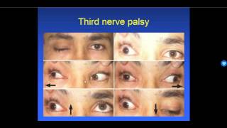 Diplopia 26  Types of Strabismus [upl. by Ahsii]