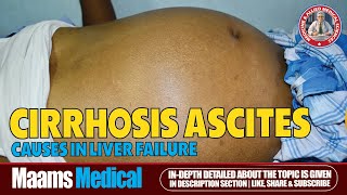 Ascites Fluid Buildup Causes Symptoms and Treatment  Maams [upl. by Jonah226]