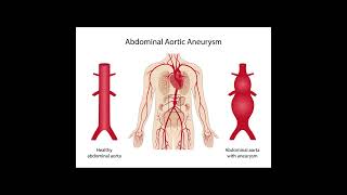 Aortic Aneurysm Symptoms and Causes  Diagnosis  Treatment  Prevention healthcare [upl. by Jinny]