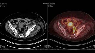 Recurrent Prostate Cancer PSMA PET CT An Insight into Bland vs tumor Thrombus [upl. by Aenea]