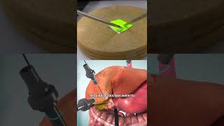 How Laparoscopic Surgery Works [upl. by Aihppa]