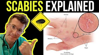 Doctor explains SCABIES skin rash including SYMPTOMS PHOTOS OF SKIN TREATMENT amp more [upl. by Yenobe261]