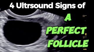 A Perfect Follicle  4 Ultrasound Signs  of Good Follicle for Easy Conceiving [upl. by Nyleimaj]