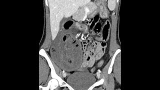 Small bowel ischemia associated with a parastomal hernia postileostomy in a Crohns disease patient [upl. by Nottap]