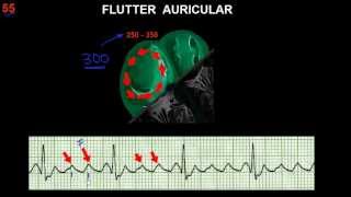 CURSO DE ELECTROCARDIOGRAFIA 55  FLUTTER Y FIBRILACIÓN AURICULARES [upl. by Trevorr]