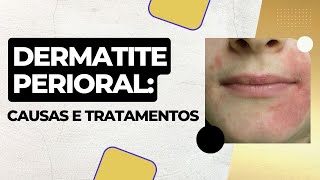 Dermatite perioral Causas e tratamento [upl. by Kaazi276]