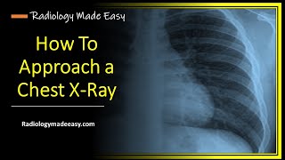 Chest X Ray  Interpretation for Medical Students and Doctors [upl. by Auston876]