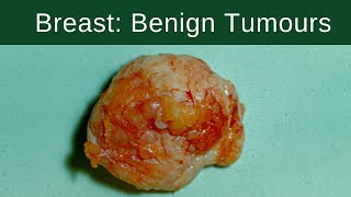 Breast Benign Tumours  Pathology mini tutorial [upl. by Bianchi]