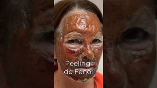 Tragedia con peeling de fenol peeling peelingdefenol fenol brazil [upl. by Kciredes]