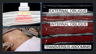 Rehabilitative Ultrasound Imaging of the Transversus Abdominis [upl. by Seabrook23]