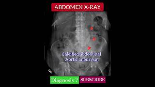 Calcified abdominal aortic aneurysm  X Ray Abdomen  Radiology [upl. by Loss]