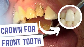 Dental Crown Front Tooth Steps Explained [upl. by Felicle]