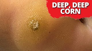 DEEPSeated Corn Removal On Dancer MUST WATCH [upl. by Clothilde405]