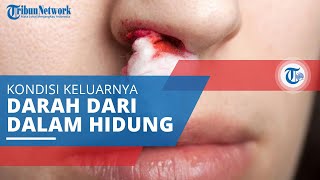 Mimisan Pendarahan dari Bagian Dalam Hidung yang Sering Disebut Juga dengan Epistaksis [upl. by Lang]