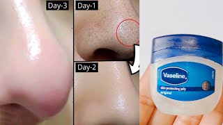 How to remove blackheads and Whiteheads from nose and face naturally at home [upl. by Towne]