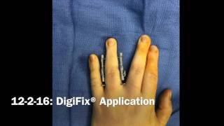 Traumatic PIP Flexion Contracture [upl. by Sarita265]