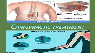 Cairopratic treatment right said shoulder and arm problem Cervical Spondylosis exercise in hindi 👍 [upl. by Brenner]