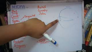 MYOPIA important concept made easy part 1 [upl. by Hultgren]