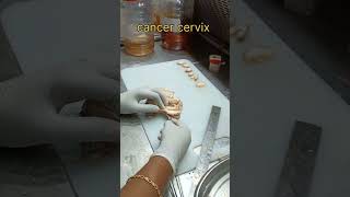 cancer cervix specimen grossing cervix  கருப்பை வாய் புற்றுநோய்  pathology cervicalcancer [upl. by Cock338]