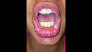 Exfoliative Cheilitis  Clobetasol Day 5 July142017 [upl. by Vaughn415]