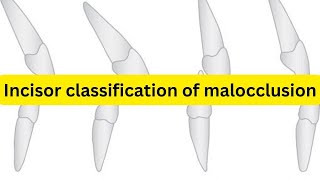 Incisor classification of malocclusion SIMPLIFIED [upl. by Llenyt]