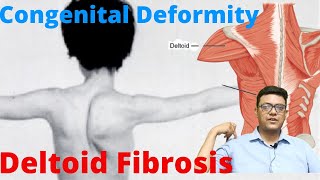 What is Deltoid Fibrosis  Reasons and treatment  Congenital Deformity [upl. by Nwahsiek]