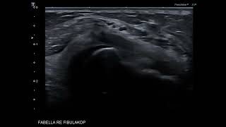 Nerve ultrasound case  fibular peroneal nerve entrapment and a fabella [upl. by Simmonds]