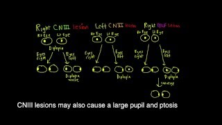 Schneid Guide to Diplopia caused by lesions to CNIII CNVI and the MLF [upl. by Foulk304]