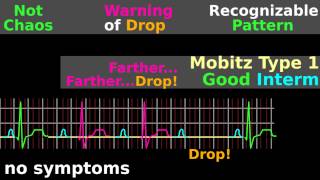 ECG Tutorial AV block EKG Mobitz electrocardiogram interpretation [upl. by Ojillib]