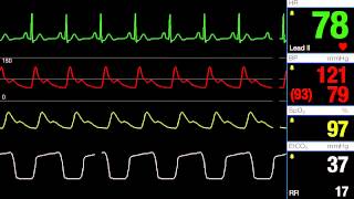 Normal Sinus Rhythm [upl. by Etteyafal]