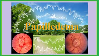 papilledema [upl. by Rolyab218]