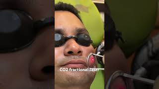 CO2 fractional laser co2 bollywood music laser treatment shorts dransharma hairregeneration [upl. by Lecrad698]