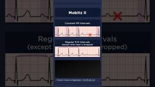 Type II Second Degree Atrioventricular Block ECG Regular RR intervals [upl. by Oninrutas]