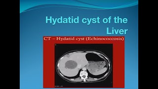 Hydatid cyst of the liver [upl. by Kore]