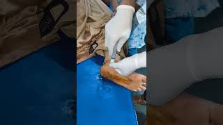 INTRAARTICULAR INJECTION FOR ANKLE PAIN [upl. by Anurb]