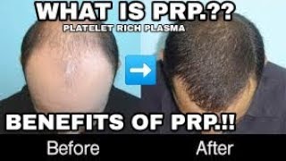 PRP Hair loss treatment  HAIR TRANSPLANT IN INDIA  INFORMATION ABOUT PLATELET RICH PLASMA PRP [upl. by Stralka482]