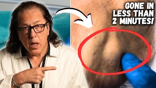 Removing a Ganglion Cyst In Less Than Two Minutes [upl. by Dominic]