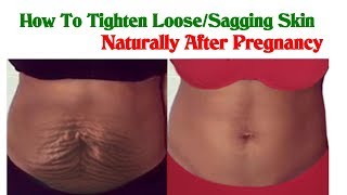 How I Tighten LooseSagging Belly Skin After PregnancyThis is Fastest Natural Method [upl. by Halpern]