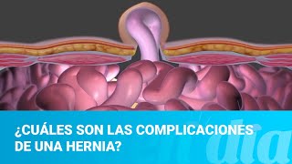 Hernias ¿Qué complicaciones pueden tener las hernias [upl. by Sullecram]