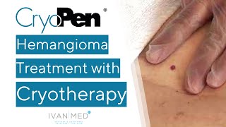 CryoPen  Treating Hemangioma with Cryotherapy [upl. by Muiram]