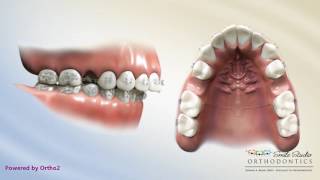 Upper 2nd Bicuspid Extraction  Overjet  Orthodontic Treatment [upl. by Siskind]