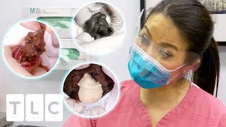 8 Satisfying Minutes Of Popping Cysts Lipomas And Blackheads  Dr Pimple Popper [upl. by Ylrak]