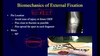 Orthopaedic Implants 2  External Fixation [upl. by Tadio]