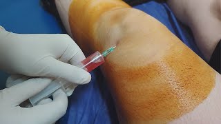 Knee fluid removal  Arthrocentesis  Synovial fluid aspiration procedure [upl. by Zonnya]