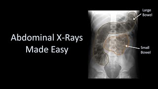 Abdominal XRays Made Easy [upl. by Ahkeber]