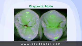 Ask Gordon caries detector for occlusal caries [upl. by Otsuj601]