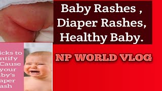 Baby Rashes  Diaper Rashes  Healthy Baby [upl. by Palermo]